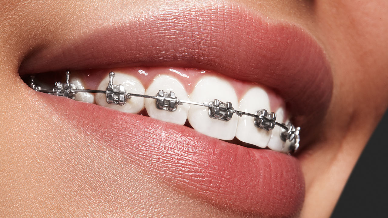 Braces For Children